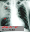 Hình ảnh Viêm phổi Thùy trên phim chụp XQuang