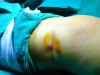 Phẫu thuật xương cẳng chân với vết mổ chỉ 01cm